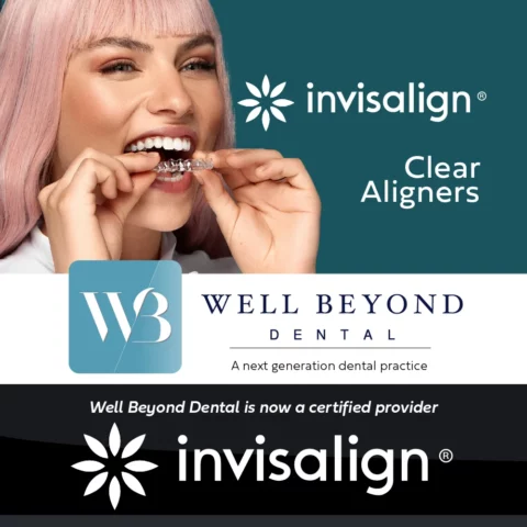 Invisalign clear aligners